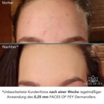 FACES OF FEY Dermaroller, Microneedling,192 echte Nadeln,  PREMIUM QUALITÄT – Bild 2