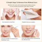 BESTOPE Mitesserentferner Komedonenquetscher Set Pinzetten Set mit Metall-Box Blackhead Remover aus Hochwertiger Edelstahl Akne Mitesser Entferner Extraktor Tools 5 Stücke – Bild 7