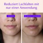 Anti-Falten-Pads für Lachfalten (Anti-Wrinkle Pads) - Feuchtigkeitsspendende & Anti-Aging-Gesichtsglättung - Klare natürliche Feuchtigkeitspflege für Lifting über Nacht - Reduziert Linien – Bild 2