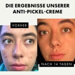 Eclat Skincare, Akne Creme für fleckige Haut, Anti Blemish Gesichtscreme für Teenager, Frauen, Männer, Reduziert dunkle Flecken, Rötungen, Ausbrüche mit Vitamin C und Salycilsäure, Feuchtigkeitspflege bei Akne – Bild 3