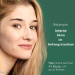 Rael Mikrokristall Akne Healing Patches - Pickel Akne Spot Tea Tree Treatment (1 Packung,9 Pflaster) – Bild 4