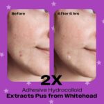 Avarelle Pickel-Abdeckpflaster PM (24 Stück) | Avarelle Pickelpflaster – 24 Uhr morgens tagsüber | Avarelle Pickel Patch Hydrocolloid - 40 Patches  | Avarelle Pickelpflaster (8 Stück) – Bild 3