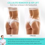 Cellulite massagegerät anti cellulite Handmassagegeräte-lymphdrainage gerät mit 3 waschbaren Pads-cellulite massagegerät elektrisch für Bauch/Bein/Arme – Bild 3