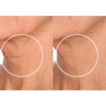 SiO Beauty FaceLift - Wiederverwendbare Anti-Falten-Pflaster für Hals, Stirn, Augen & Lächeln