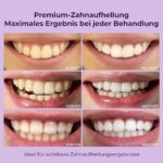 OnlySmile Zahnbleaching Set – Professionelles All-in-One Teeth Whitening Kit für sofort weisse Zähne