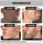 Anthony Brown® Beard Growth Serum – Männer Bartwuchs Serum mit Capilia Longa – Belegte Wirkung für mehr Bartwuchs ohne Nebenwirkungen