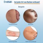 Evolsin® Silikon Narbenpflaster – Transparent & Zuschneidbar (200cm) – Ideal für OP- & Kaiserschnittnarben