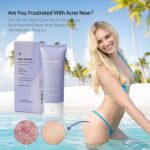 Tobcharm Anti-Akne Körpercreme – Mit Azelainsäure, 100 ml