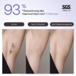 Ulike Air 3 Deluxe IPL Haarentfernungsgerät – Saphir-Eiskühlung für Gesicht & Körper – Bild 5