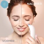 Essy Mitesserentferner mit 5 Saugstufen – Porenreinigungsgerät für alle Hauttypen – Bild 3