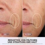 Shark CryoGlow LED-Gesichtsmaske – Lichttherapie mit Augenkühlung & Fernbedienung – Bild 9